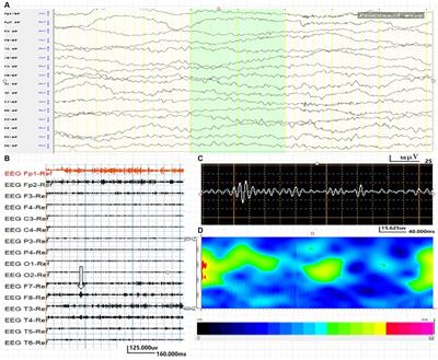 Application of High-Frequency Oscillations on Scalp EEG in Infant Spasm: A Prospective Controlled Study